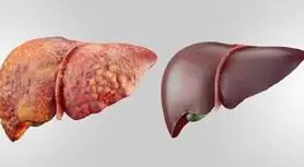 این نشانه ها علائم اولیه آسیب کبدیه | تا این نشانه هارو دیدی سریع برو دکتر