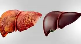 این نشانه ها علائم اولیه آسیب کبدیه | تا این نشانه هارو دیدی سریع برو دکتر