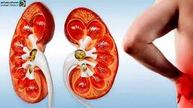  سنگ کلیه را با خوردن چه چیزهایی نابود کنیم؟ 