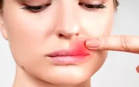 درمان یک روزه تبخال لب با این ترفندها
