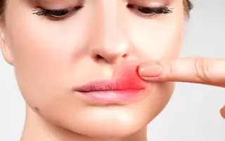 درمان یک روزه تبخال لب با این ترفندها