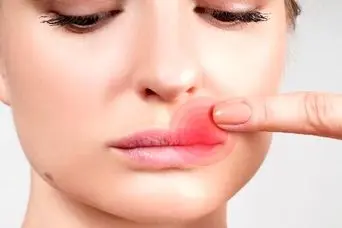 درمان یک روزه تبخال لب با این ترفندها