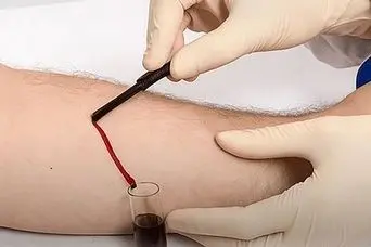 فصد خون چیست؟ فواید شگفت‌انگیز، عوارض احتمالی و بهترین زمان انجام آن