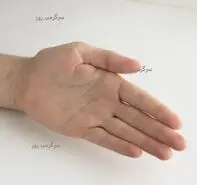 هشدار مرگبار | این علائم روی دست نشان از این بیماری هاست