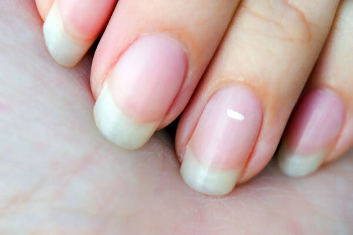 سفیدی داخل ناخن انگشت های دست این بیماری مرگ آور را نشان می دهد + راه حل درمانی