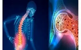  استخوان‌های محکم و قوی می خواهید ؟ این ویتامین راه حل شماست 