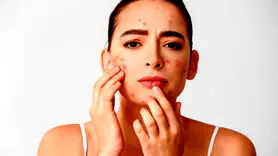  چند درمان خانگی برای رفع فوری جوش‌های صورت 