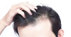 کلید درمان کامل طاسی و ریزش مو را بشناسید
