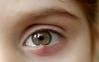 سریع ترین روش های درمان خانگی گل مژه