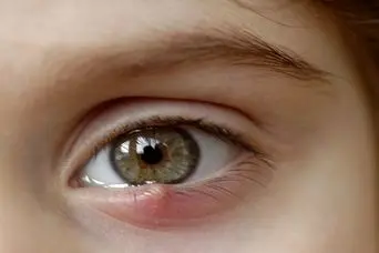 سریع ترین روش های درمان خانگی گل مژه