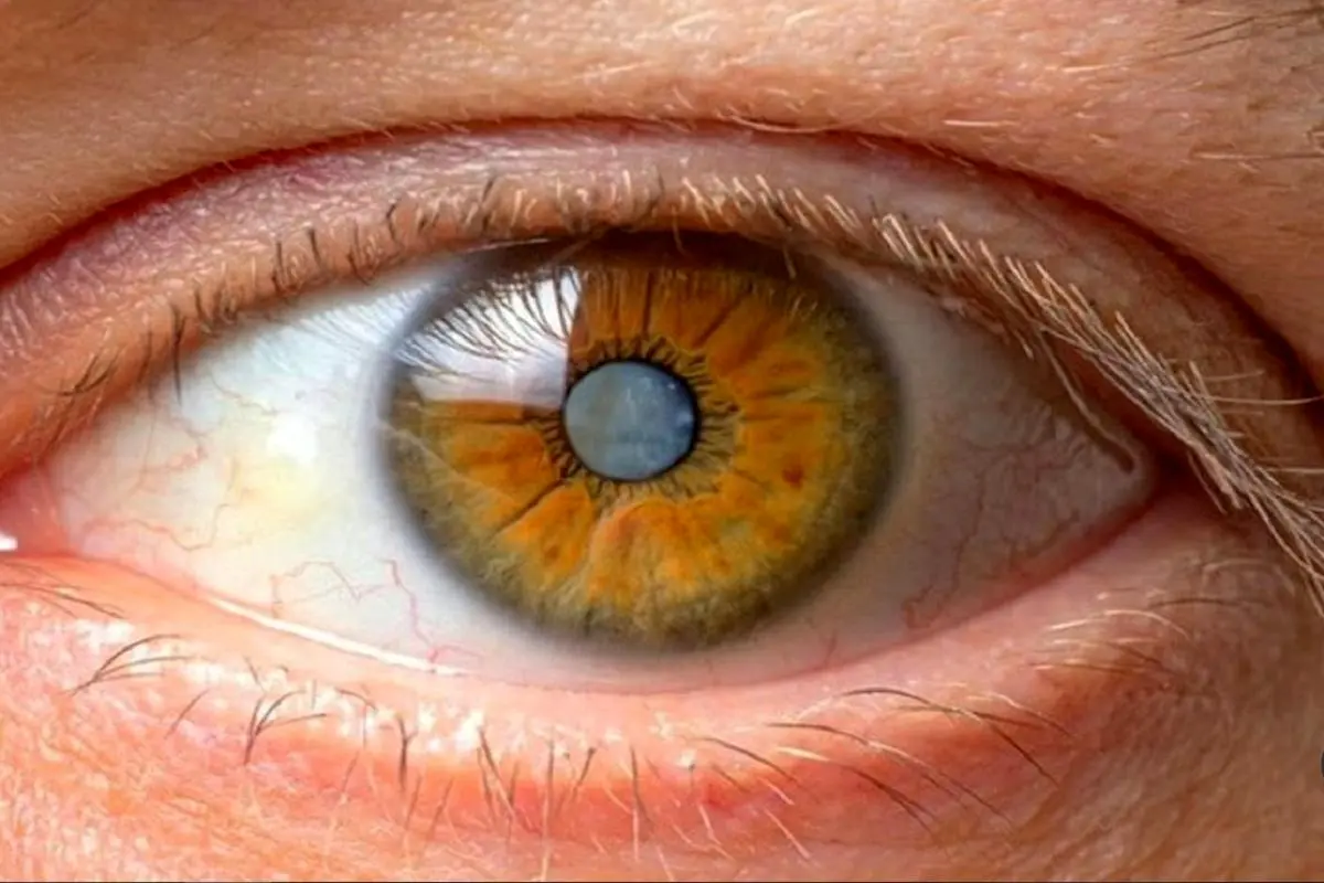 پیشگیری از آب مروارید با این راهکارهای ساده