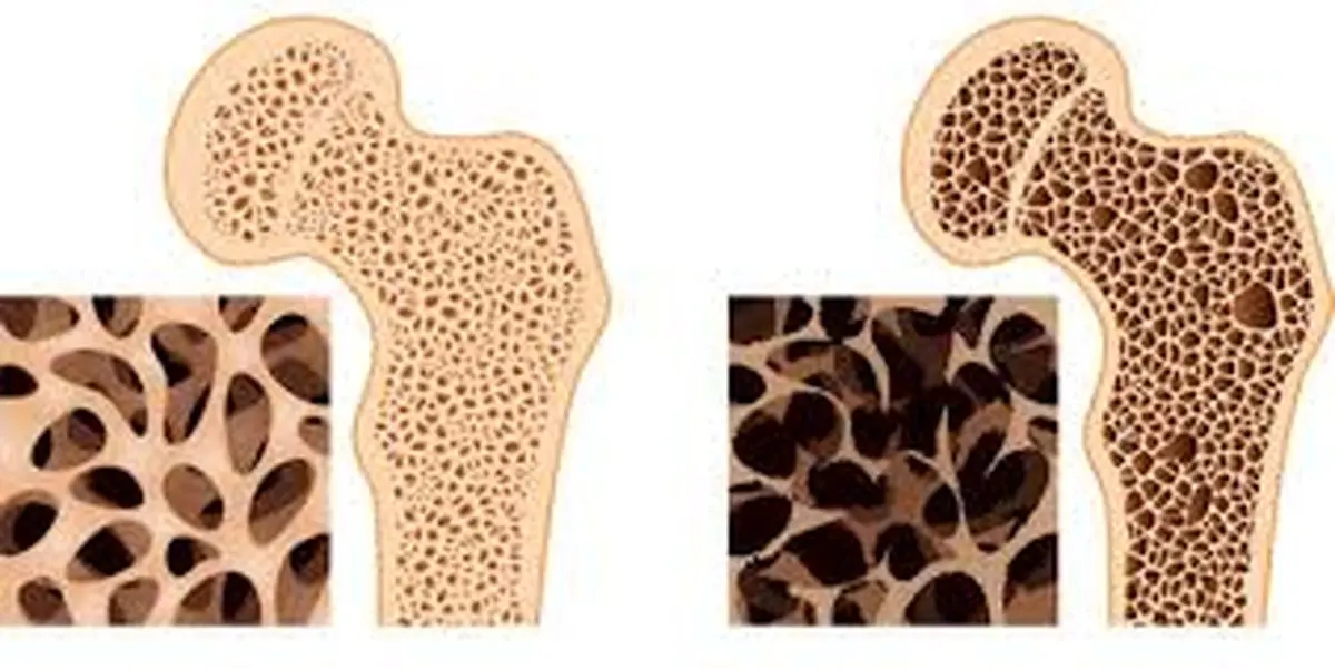 این داروی گیاهی استخوان سازی می کند + ترمیم ناخن های شکسته و دیسک کمر و درمان ساییدگی 