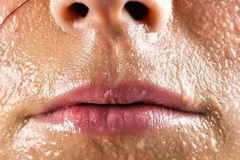 علت عرق زیاد سر و صورت چیست؟ / بررسی جامع علل و نحوه درمان