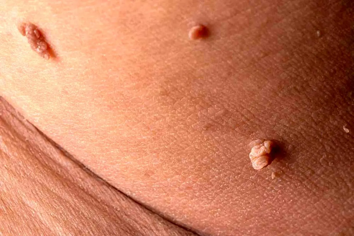 تفاوت خال گوشتی و زگیل | کندن زگیل با ناخنگیر یا بستن نخ خطرناک است؟