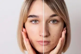 ترفند از بین بردن جای جوش در یک روز در خانه ؛ ترکیب گیاهی دست ساز فوری