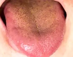 علائم کبد چرب در زبان