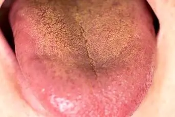 علائم کبد چرب در زبان