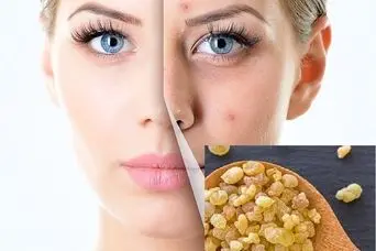 خواص ضدپیری این گیاه ارزشمند؛  لیفت و درخشندگی و جوان‌‌سازی پوست با کندر