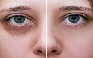 مهمترین علت‌های مهم گودی زیر چشم + بهترین روش های درمان خانگی رفع گودی چشم