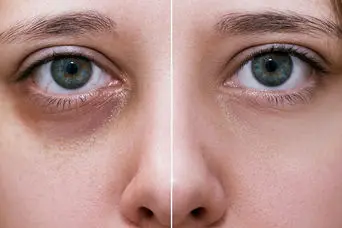 مهمترین علت‌های مهم گودی زیر چشم + بهترین روش های درمان خانگی رفع گودی چشم