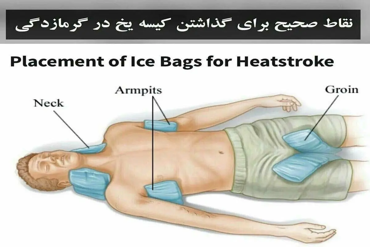  نقاط صحیح برای گذاشتن کیسه یخ در بدن | تو این گرمای شدید خودتو از گرمازدگی دور کن