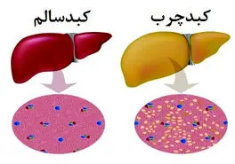  گیاهی برای غلبه بر کبد چرب 