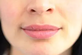 تو سیم ثانیه تبخال صورتت رو از بین ببر + روش کاملا خانگی