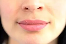 تو سیم ثانیه تبخال صورتت رو از بین ببر + روش کاملا خانگی
