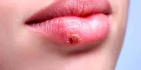 تبخال رو تو سیم ثانیه تار و مار کن | درمان خانگی و فوری تبخال