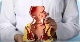 بواسیر و درمان‌های خانگی که به مردم کمک کرد؛ چه زمانی باید به پزشک مراجعه کرد؟