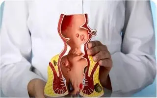 بواسیر و درمان‌های خانگی که به مردم کمک کرد؛ چه زمانی باید به پزشک مراجعه کرد؟