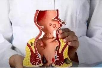 بواسیر و درمان‌های خانگی که به مردم کمک کرد؛ چه زمانی باید به پزشک مراجعه کرد؟