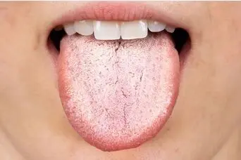 زبانت چه مزه‌ای می‌دهد؟ همین حالا از روی زبانت بیماری‌ات را کشف کن