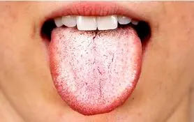 اگر زبان سفیدی دارید این خبر برای شماست