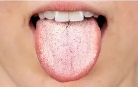 اگر زبان سفیدی دارید این خبر برای شماست