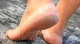 چگونه ترک کف پا را سریع و موثر درمان کنیم؟؛ درمان خانگی ترک کف پا تنها در 2 روز