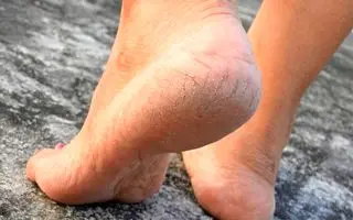 چگونه ترک کف پا را سریع و موثر درمان کنیم؟؛ درمان خانگی ترک کف پا تنها در 2 روز