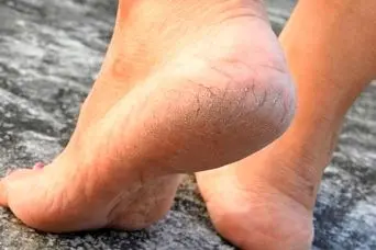 چگونه ترک کف پا را سریع و موثر درمان کنیم؟؛ درمان خانگی ترک کف پا تنها در 2 روز