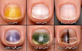انواع بیماری‌های ناخن و راه درمان آن‌