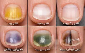 انواع بیماری‌های ناخن و راه درمان آن‌