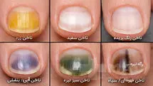 انواع بیماری‌های ناخن و راه درمان آن‌