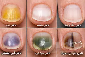 انواع بیماری‌های ناخن و راه درمان آن‌