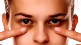 از بین بردن کبودی و سیاهی زیر و دور چشم برای همیشه | با این روش های خانگی از شر سیاهی دور چشم خلاص شو