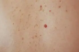 اگر خال بدنتان این رنگی است در معرض سرطان هستید