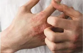  با این راهکارها از خشکی پوست جلوگیری کنید 