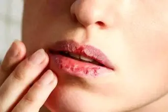 بهترین پماد برای ترک لب؛ درمان سریع لب‌های خشک و زخم‌شده