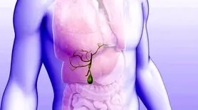 این مواد غذایی کیسه صفراتو نابود میکنه! | تهدید سلامت کیسه صفرا با مصرف چند ماده غذایی