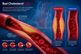 چگونه LDL (کلسترول بد) خون را کاهش دهیم؟