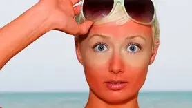 آفتاب سوختگی را با مالیدن این مواد خونگی و طبیعی کمتر از 10 دقیقه از بین ببر