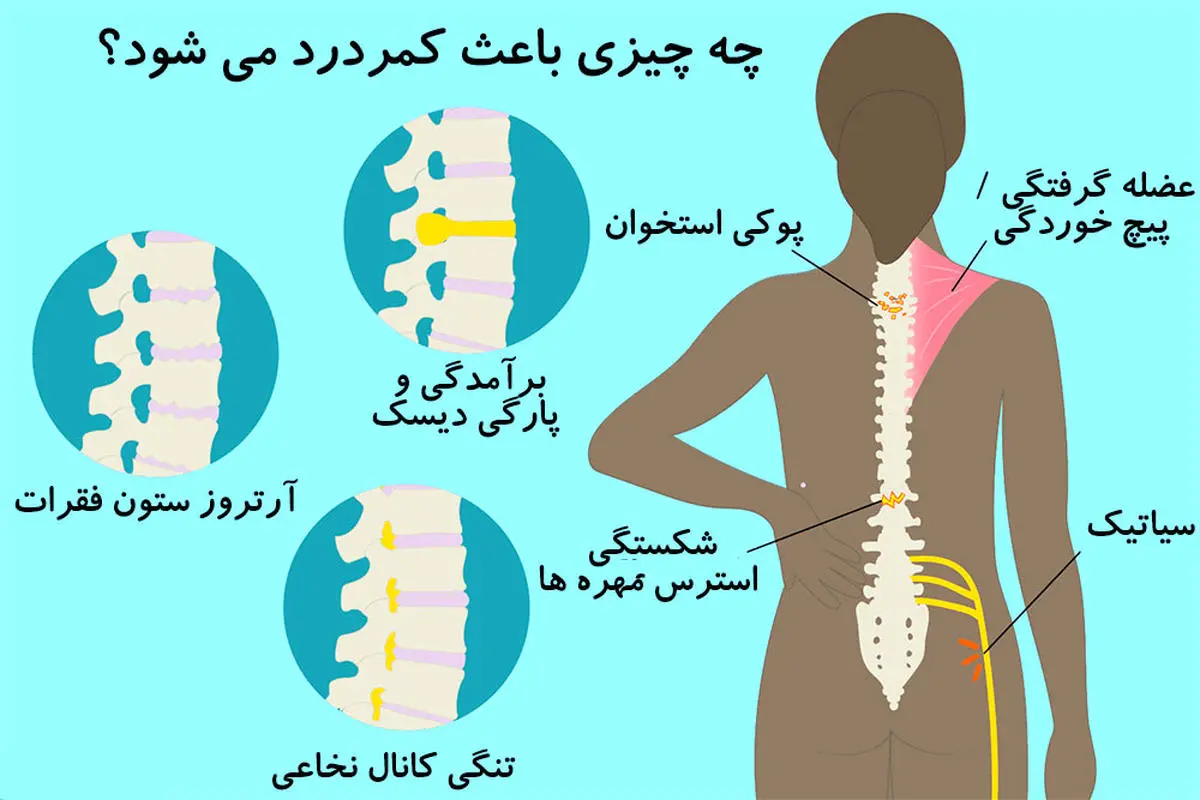  درد کمر را ساده تلقی نکنید | علامت هشدار دهنده خطرناک ترین بیماری ها 